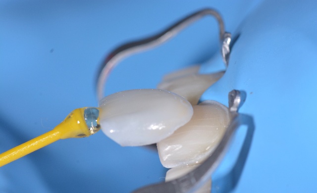 Restaurations partielles collées postérieures ; inlay, onlay 