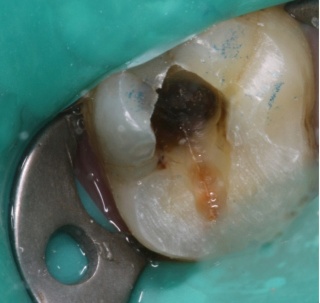 Maitriser les thérapeutiques de vitalité pulpaire 