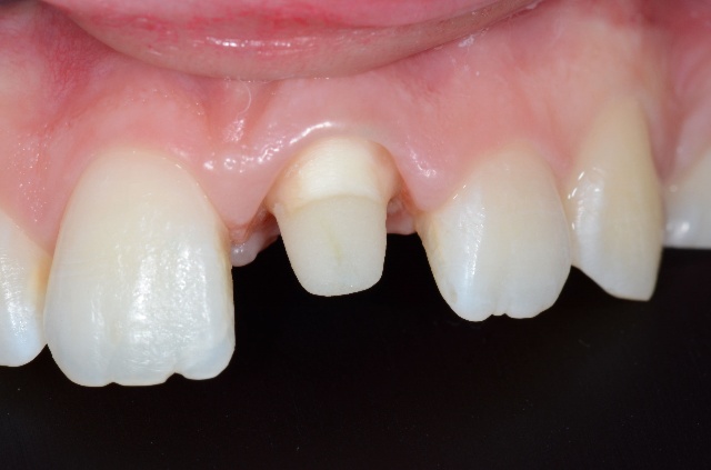 Reconstitutions corono-radiculaires : le tenon en question 
