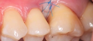 Incisions et sutures 