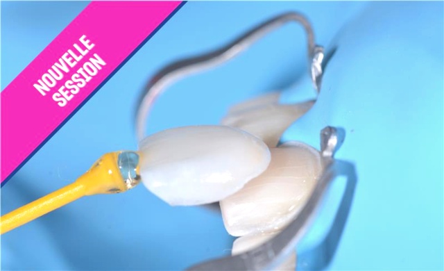 Restaurations partielles collées postérieures ; inlay, onlay 