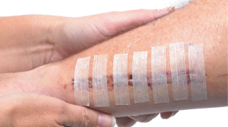 Plaies et cicatrisation 